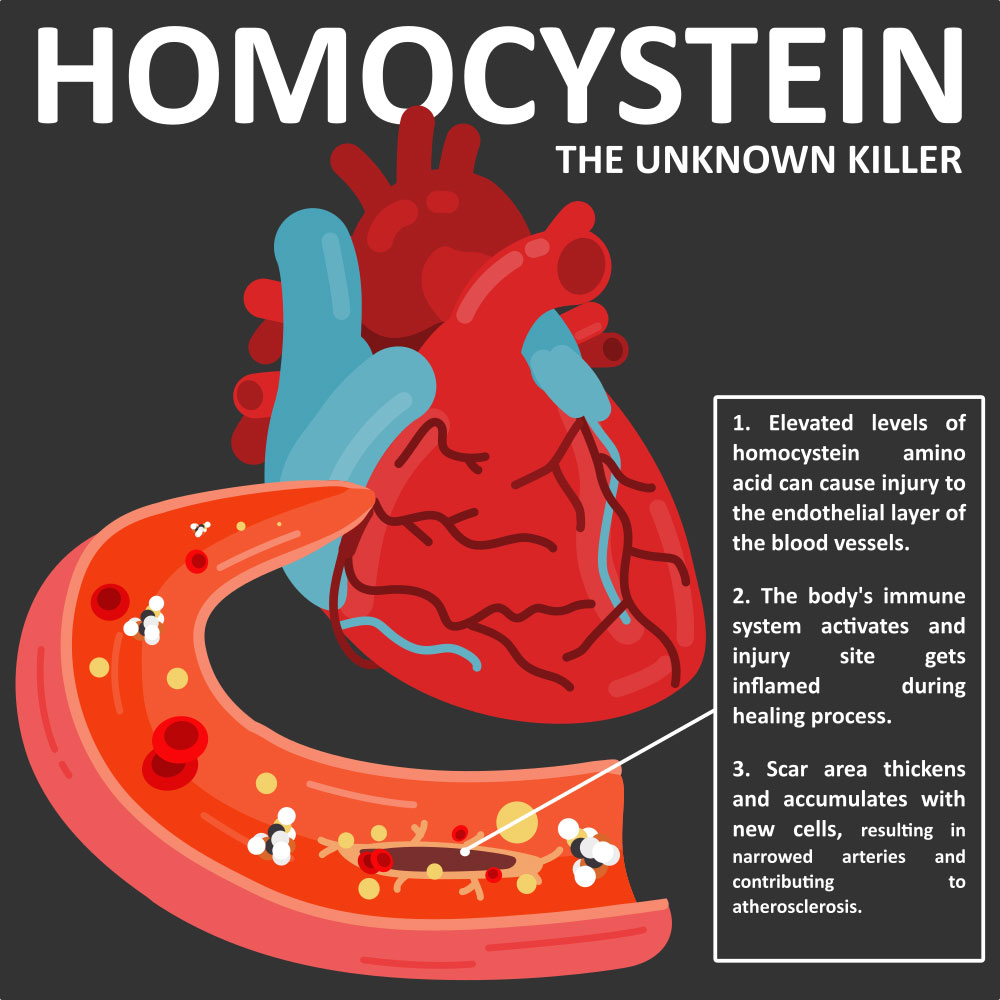 homocysteine-arteries-killer